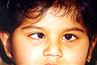 Squint: Misalignment of eyes
